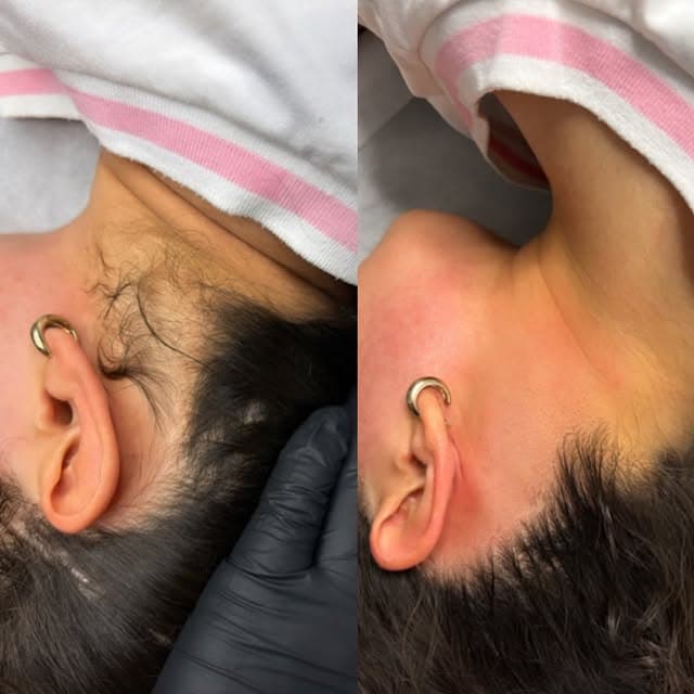 טיפול לייזר